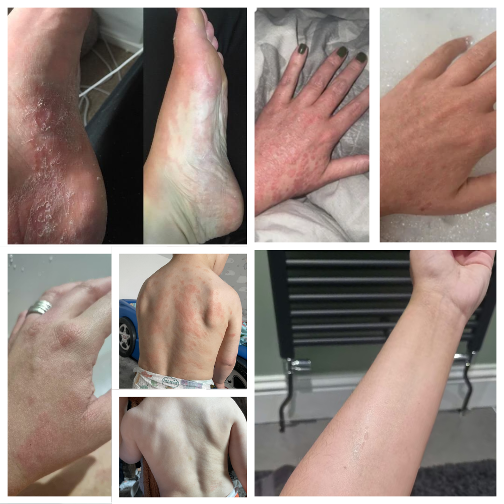 Propolis Skin Relief Balm - Intensive Repair Balm for Eczema-Prone & Psoriasis-Prone Skin