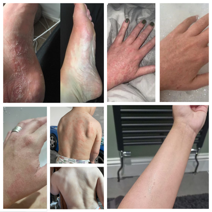 Propolis Skin Relief Balm - Intensive Repair Balm for Eczema-Prone & Psoriasis-Prone Skin