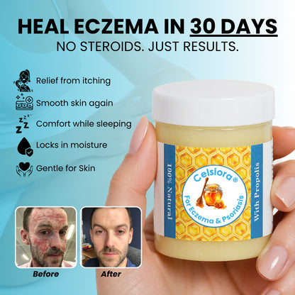Propolis Skin Relief Balm - Intensive Repair Balm for Eczema-Prone & Psoriasis-Prone Skin